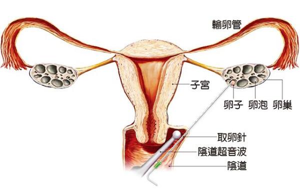 试管婴儿